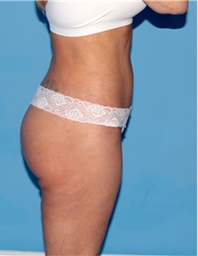 Body Contouring After Photo by Siamak Agha, MD PhD FACS; Newport Beach, CA - Case 44058