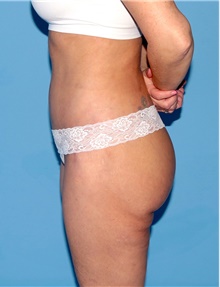 Body Contouring After Photo by Siamak Agha, MD PhD FACS; Newport Beach, CA - Case 44058