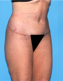 Body Contouring After Photo by Siamak Agha, MD PhD FACS; Newport Beach, CA - Case 44070