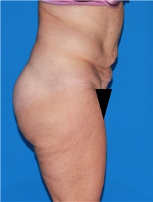 Body Contouring Before Photo by Siamak Agha, MD PhD FACS; Newport Beach, CA - Case 44070