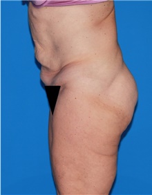 Body Contouring Before Photo by Siamak Agha, MD PhD FACS; Newport Beach, CA - Case 44070