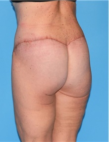 Body Contouring After Photo by Siamak Agha, MD PhD FACS; Newport Beach, CA - Case 44070
