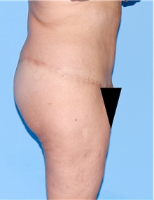 Body Contouring After Photo by Siamak Agha, MD PhD FACS; Newport Beach, CA - Case 44071