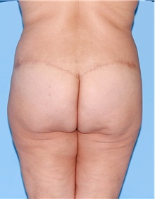 Body Contouring After Photo by Siamak Agha, MD PhD FACS; Newport Beach, CA - Case 44071