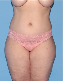 Body Contouring After Photo by Siamak Agha, MD PhD FACS; Newport Beach, CA - Case 44072