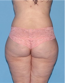 Body Contouring After Photo by Siamak Agha, MD PhD FACS; Newport Beach, CA - Case 44072