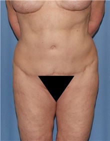 Body Contouring Before Photo by Siamak Agha, MD PhD FACS; Newport Beach, CA - Case 44073