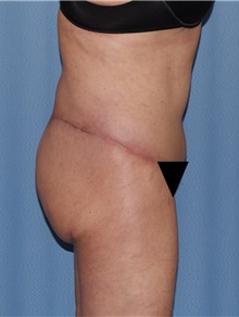 Body Contouring After Photo by Siamak Agha, MD PhD FACS; Newport Beach, CA - Case 44073