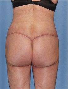 Body Contouring After Photo by Siamak Agha, MD PhD FACS; Newport Beach, CA - Case 44073