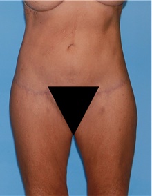 Body Contouring After Photo by Siamak Agha, MD PhD FACS; Newport Beach, CA - Case 44074