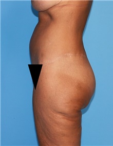 Body Contouring Before Photo by Siamak Agha, MD PhD FACS; Newport Beach, CA - Case 44074