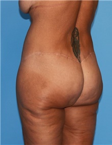 Body Contouring Before Photo by Siamak Agha, MD PhD FACS; Newport Beach, CA - Case 44074