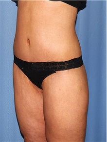 Body Contouring After Photo by Siamak Agha, MD PhD FACS; Newport Beach, CA - Case 44075