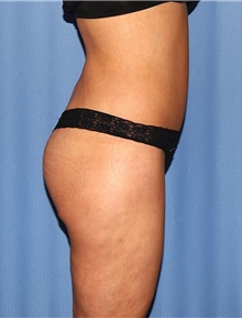 Body Contouring After Photo by Siamak Agha, MD PhD FACS; Newport Beach, CA - Case 44075