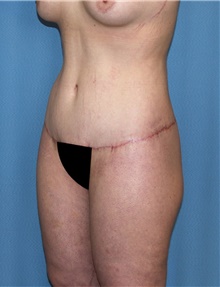 Body Contouring After Photo by Siamak Agha, MD PhD FACS; Newport Beach, CA - Case 44076