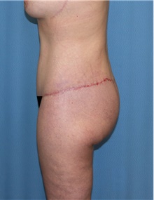 Body Contouring After Photo by Siamak Agha, MD PhD FACS; Newport Beach, CA - Case 44076