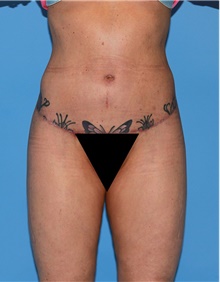 Body Contouring After Photo by Siamak Agha, MD PhD FACS; Newport Beach, CA - Case 44077