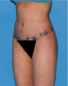 Body Contouring After Photo by Siamak Agha, MD PhD FACS; Newport Beach, CA - Case 44077