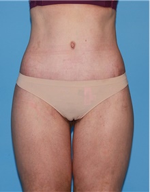 Body Contouring After Photo by Siamak Agha, MD; Newport Beach, CA - Case 44078