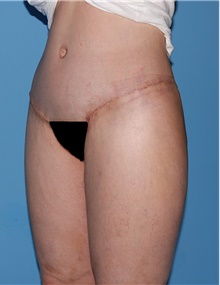 Body Contouring After Photo by Siamak Agha, MD; Newport Beach, CA - Case 44078