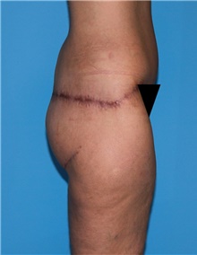 Body Contouring Before Photo by Siamak Agha, MD; Newport Beach, CA - Case 44078