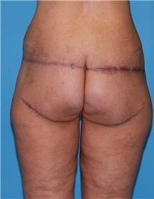 Body Contouring Before Photo by Siamak Agha, MD; Newport Beach, CA - Case 44078
