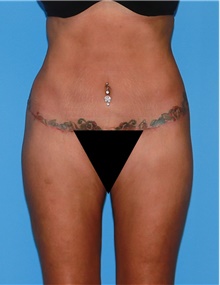 Body Contouring After Photo by Siamak Agha, MD PhD FACS; Newport Beach, CA - Case 44079