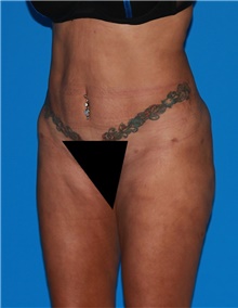 Body Contouring Before Photo by Siamak Agha, MD PhD FACS; Newport Beach, CA - Case 44079