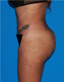 Body Contouring Before Photo by Siamak Agha, MD PhD FACS; Newport Beach, CA - Case 44079