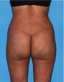 Body Contouring After Photo by Siamak Agha, MD PhD FACS; Newport Beach, CA - Case 44079