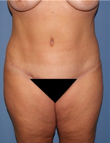 Body Contouring After Photo by Siamak Agha, MD; Newport Beach, CA - Case 44080
