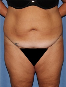 Body Contouring Before Photo by Siamak Agha, MD; Newport Beach, CA - Case 44080