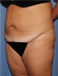 Body Contouring Before Photo by Siamak Agha, MD PhD FACS; Newport Beach, CA - Case 44080