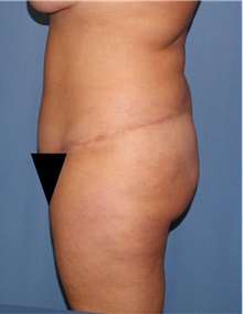Body Contouring After Photo by Siamak Agha, MD PhD FACS; Newport Beach, CA - Case 44080