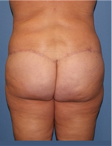 Body Contouring After Photo by Siamak Agha, MD PhD FACS; Newport Beach, CA - Case 44080