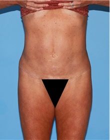 Body Contouring After Photo by Siamak Agha, MD PhD FACS; Newport Beach, CA - Case 44084