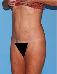 Body Contouring After Photo by Siamak Agha, MD PhD FACS; Newport Beach, CA - Case 44084