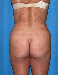 Body Contouring Before Photo by Siamak Agha, MD PhD FACS; Newport Beach, CA - Case 44084