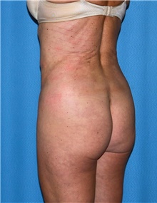 Body Contouring Before Photo by Siamak Agha, MD PhD FACS; Newport Beach, CA - Case 44084