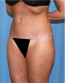Body Contouring After Photo by Siamak Agha, MD PhD FACS; Newport Beach, CA - Case 44085