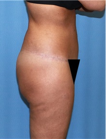 Body Contouring After Photo by Siamak Agha, MD PhD FACS; Newport Beach, CA - Case 44085