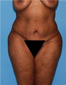 Body Contouring Before Photo by Siamak Agha, MD; Newport Beach, CA - Case 44086