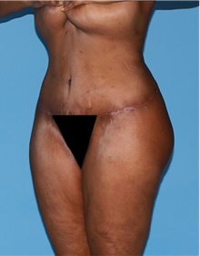 Body Contouring After Photo by Siamak Agha, MD; Newport Beach, CA - Case 44086