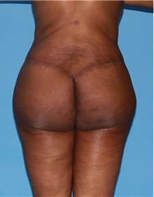 Body Contouring After Photo by Siamak Agha, MD; Newport Beach, CA - Case 44086