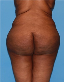 Body Contouring Before Photo by Siamak Agha, MD; Newport Beach, CA - Case 44086