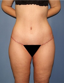 Body Contouring After Photo by Siamak Agha, MD; Newport Beach, CA - Case 44088
