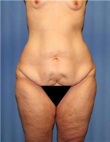 Body Contouring Before Photo by Siamak Agha, MD; Newport Beach, CA - Case 44088