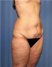 Body Contouring Before Photo by Siamak Agha, MD PhD FACS; Newport Beach, CA - Case 44088