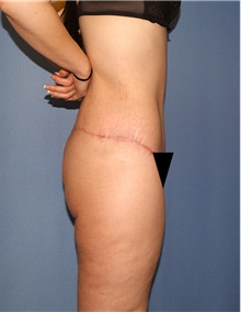 Body Contouring After Photo by Siamak Agha, MD PhD FACS; Newport Beach, CA - Case 44088
