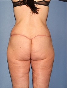 Body Contouring After Photo by Siamak Agha, MD PhD FACS; Newport Beach, CA - Case 44088